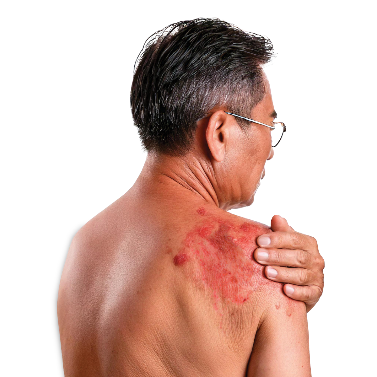 Shingles Vaccination